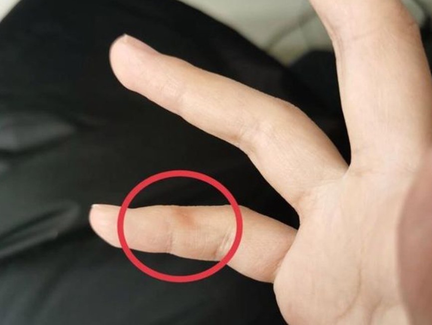 小拇指凹坑,就是新时代的“手机病”