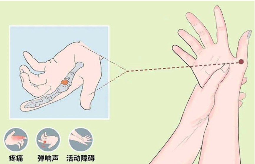 小拇指凹坑,就是新时代的“手机病”